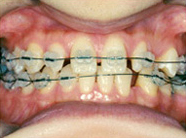 矯正を併用した審美治療