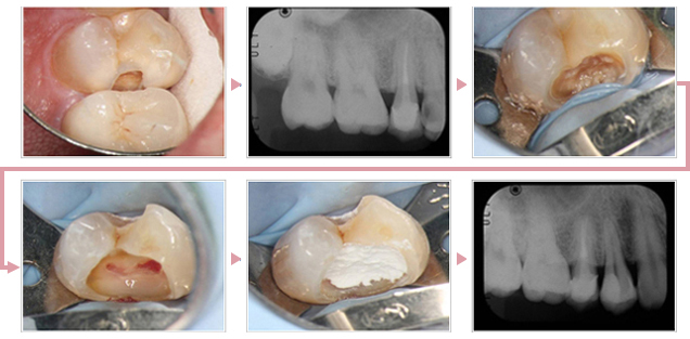 歯髄の保存