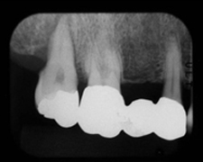 歯冠歯根破折