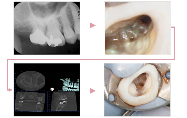 見つからない根管への対応（CTによる診査）