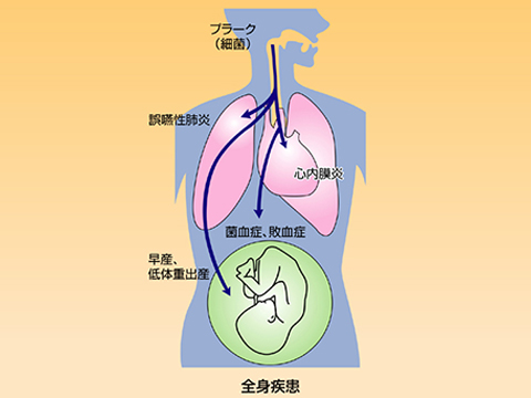 歯周病が体に及ぼす影響